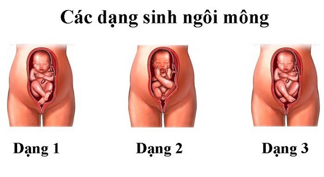 tư thế nằm của thai nhi trong bụng mẹ